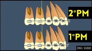 Extracción de segundos premolares en ortodoncia [upl. by Helli]