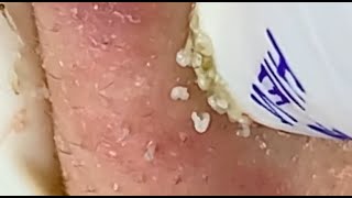 Blackheads super lotRemove Blackheads on FaceSatisfying Video [upl. by Rbma312]