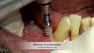 Straumann Tissue Level Implant with prosthesis [upl. by Mad416]