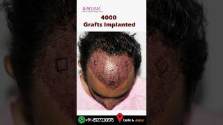 4000 FUE Grafts Hai Transplant Results by Dr Suneet Soni at Medispa Hair Transplant Clinic [upl. by Onirefez]