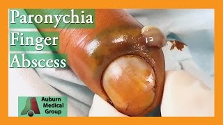 Paronychia Fingernail Abscess Infection Treatment  Auburn Medical Group [upl. by Etnaud]