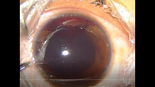 Traumatic Hyphema  Hyphemectomy Under Topical Anesthesia Unedited HD [upl. by Lindsey]