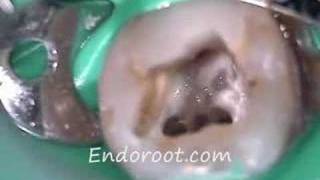 Retratamiento de endodoncia con 3 conductos mesiales [upl. by Sirtimed]