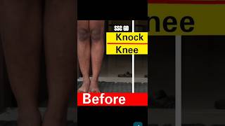 SSC GD Medical Knock Knee Test ssc sscgd bsfjammu [upl. by Fiester]