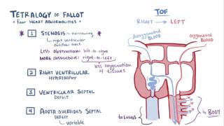 Tetralogy of fallot TOF repair causes symptoms amp pathology [upl. by Ralyat]