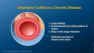 What is Ulcerative Colitis [upl. by Euqram]