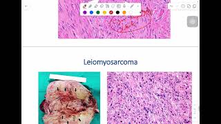 MSS pathology lab 1  part 4 [upl. by Dnalloh]