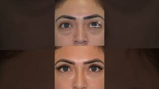 Before amp After Under Eye Filler [upl. by Clementi]