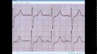 ECG CALCULATION OF HEART RATE METHOD  2 The Countdown Method [upl. by Ailegna]