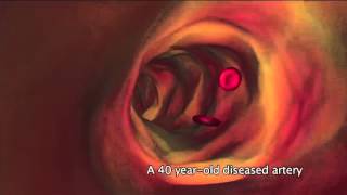 What is atherosclerosis [upl. by Yunick597]