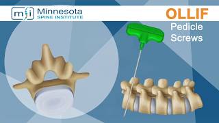 Minimally Invasive Oblique Lateral Lumbar Interbody Fusion OLLIF  the Minnesota Spine Institute [upl. by Newton55]