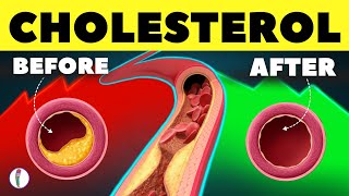 10 Natural Ways to Clear Your Artery  High Cholesterol  LDL  HDL  Heart Attack prevention tips [upl. by Walli]