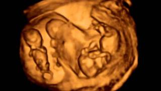 3D ultrasound Dichorionic triamniotic triplets 12 weeks [upl. by Manya]