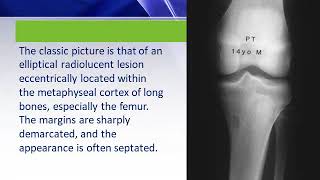 Non ossifying fibroma DrMSubbiah MD Pediatrics [upl. by Panaggio308]