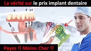 Prix implant dentaire  partie 1 [upl. by Edlin]