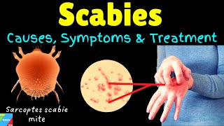 Scabies Causes Symptoms Diagnosis Treatment amp Prevention [upl. by Elana]