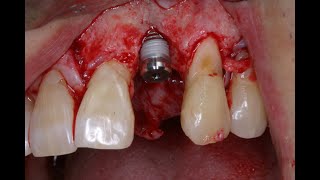 Simple 3 D ridge augmentation using Stickybone and a tenting abutment [upl. by Noe]