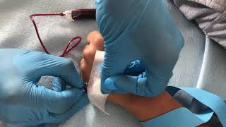 Venipuncture Butterfly Method [upl. by Earvin]