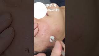 리팟 레이저 다발성 흑자 세종리팟 세종시리팟 reepot lentigo multiplelentigo 청주리팟 공주리팟 대전리팟 오창리팟 오송리팟 부여리팟 [upl. by Crompton]