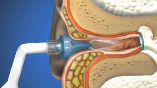 Bionix® OtoClear® Ear Irrigation [upl. by Jerald]