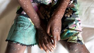 Mpox cases reported in several Congo Basin countries [upl. by Ansaev163]