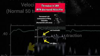 Low Velocities and Thrombus in LAA of Heart ♥ echocardiography [upl. by Morrell918]