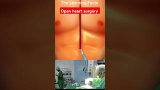 Open heart cardiac surgery 3Danimationmedicalcollegenursingstudentthelearningfactsmedicalstudent [upl. by Nelleyram957]