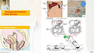 Peritonitis Part 1 Anatomy of peritoneum [upl. by Thomajan666]