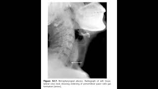 Acute retropharyngeal abscess [upl. by Madelaine73]