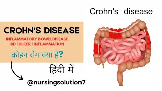 Crohns disease in hindi  Inflammatory bowel disease in hindi  Type  Cause  Symptoms  Treatment [upl. by Ewall]