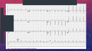 Recognizing and Managing Atrial Flutter in the Emergency Department  ECG Case Study [upl. by Jeanine]