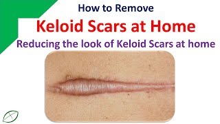 How to Remove Keloid Scars at Home  Reducing the look of Keloid Scars at home [upl. by Hemphill753]