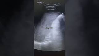 Hepatic calcification on USGcomedy usg trending baby usgsfactsviralvideoshorts youtubeshort [upl. by Zebedee829]