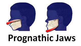 Treatment of Prognathic Jaw Jaw Pushing Forward by Prof John Mew [upl. by Leval]