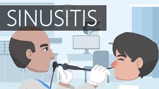 What is Sinusitis [upl. by Nifares]