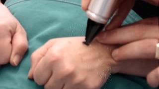 Lentigo Mani Alex QS Laser [upl. by Suoirtemed]