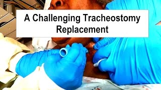 A Challenging Tracheostomy Replacement [upl. by Ahsemad]