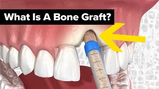 Dental Bone Grafts Explained [upl. by Aisatsanna]