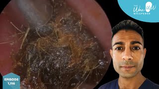 1116  7 Years Buildup of Dark Impacted Ear Wax Removal [upl. by Ainad]