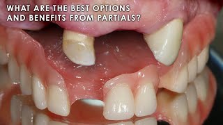 What are the Best Options and Benefits from Partials [upl. by Bearce506]