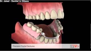 Prosthodontics  Precision Partial Denture  Ottawa Dentist [upl. by Ainitsirc]