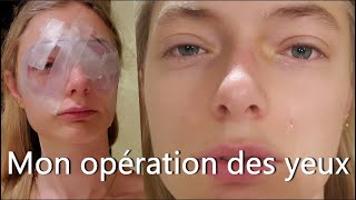 OPÉRATION HYPERMÉTROPIE FORTE ET ASTIGMATISME  Lasik [upl. by Gnud347]