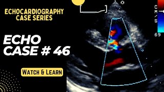 Echo Case 46 Echocardiography Spot Diagnosis Series  Cardiology [upl. by Margi]