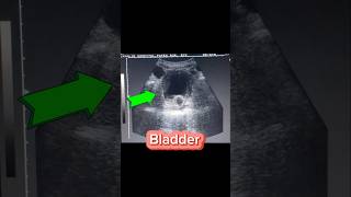 Cystitis  Foley Catheter in situ  Thick walled U Bladder on Ultrasound [upl. by Zanze]