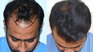 Hair Transplant Results USA Canada UAE  Medispa India JaipurDelhi by Dr Suneet Soni [upl. by Irahk980]