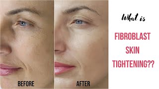 What is Fibroblast Skin Tightening [upl. by Cora]