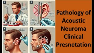 3 Pathology of Acoustic Neuroma Clinical Presnetation [upl. by Miru]