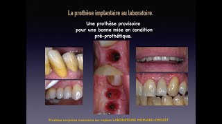 Provisoire sur implant avec armature interne [upl. by Odeen]