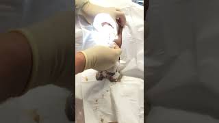 Exploding grapefruit sized sebaceous cyst popping [upl. by Lladnarc]