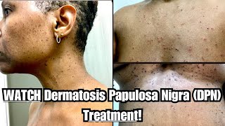 Dermatosis Papulosa Nigra DPN Removal 😵😀 QuestionAnswer [upl. by Tammy]